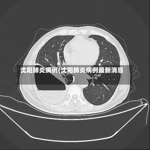沈阳肺炎病例(沈阳肺炎病例最新消息)-第2张图片